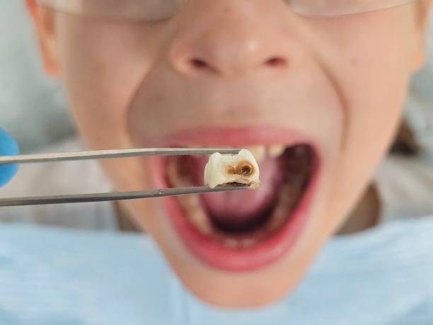 Tooth Infection Emergency Dentist in WV